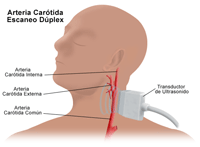 Ilustración de una tomografía dúplex de las arterias carótidas